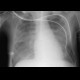 Pulmonary edema, supine chest radiograph: X-ray - Plain radiograph